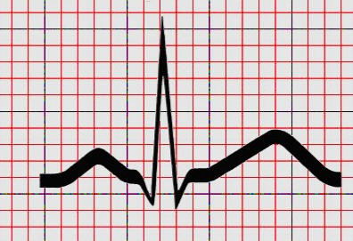 Entendendo o ECG Normal